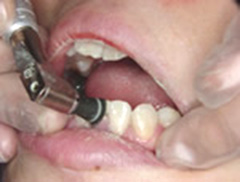 予防・歯周治療